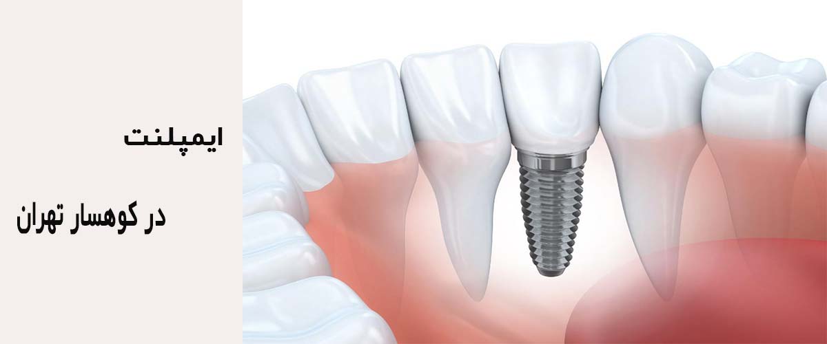 ایمپلنت در کوهسار تهران