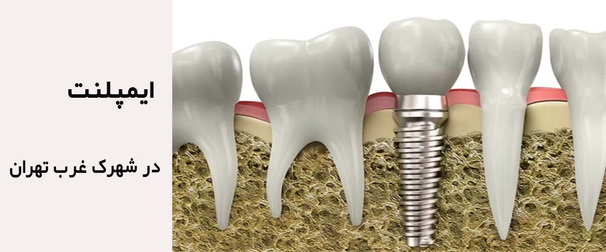 ایمپلنت در شهرک غرب تهران