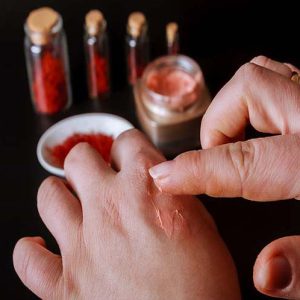 جای زخم ورامین