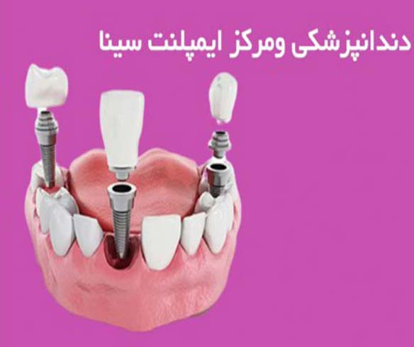 مرکز تخصصی ایمپلنت سینا